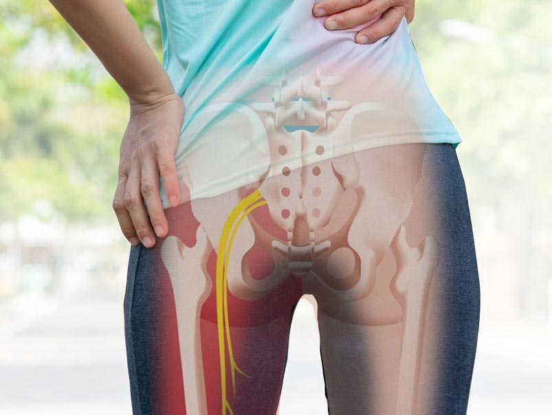 The hips of feet of a woman holding her hip and lower back and there is an image of skeletal structure showing the hip the leg bones and the lower spine of the woman highlighting the sciatic nerve in yellow which will need a professional chiropractor who will help the person lessen the discomfort in the Sciatic nerve and support her well being.